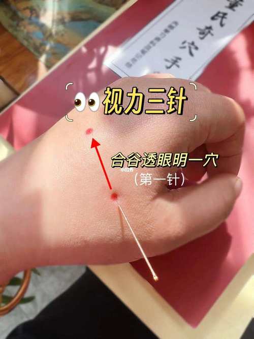 眼睛模糊可以针灸吗