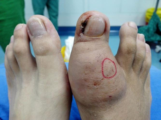 痛风的症状早期脚趾头