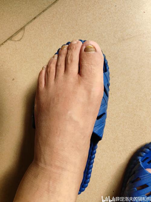 痛风的症状早期脚趾头