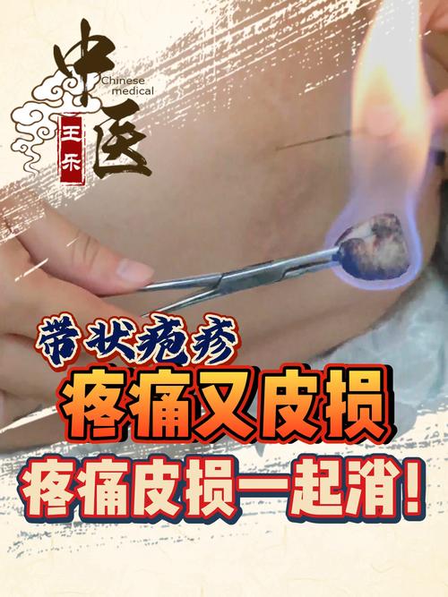 皮炎可以针灸治疗吗