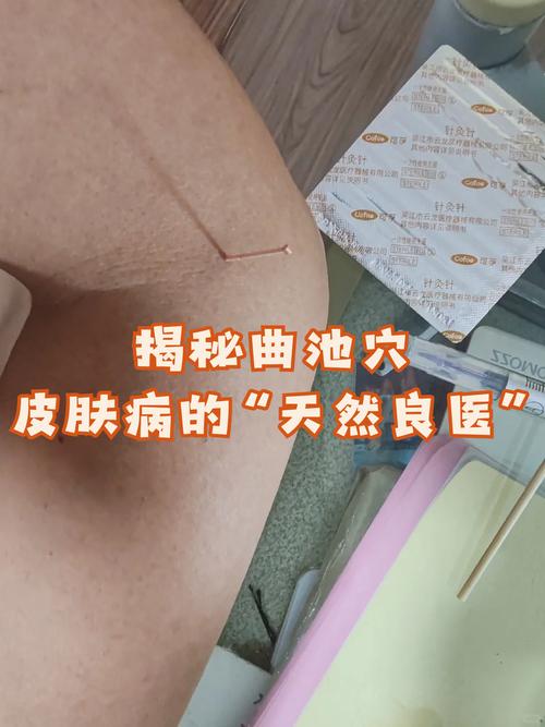 皮炎可以针灸治疗吗