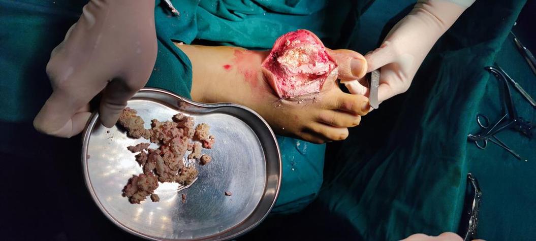 痛风石可以手术切除吗