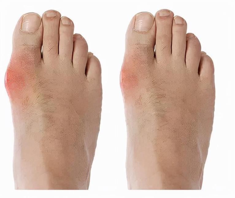 脚上痛风什么症状图片