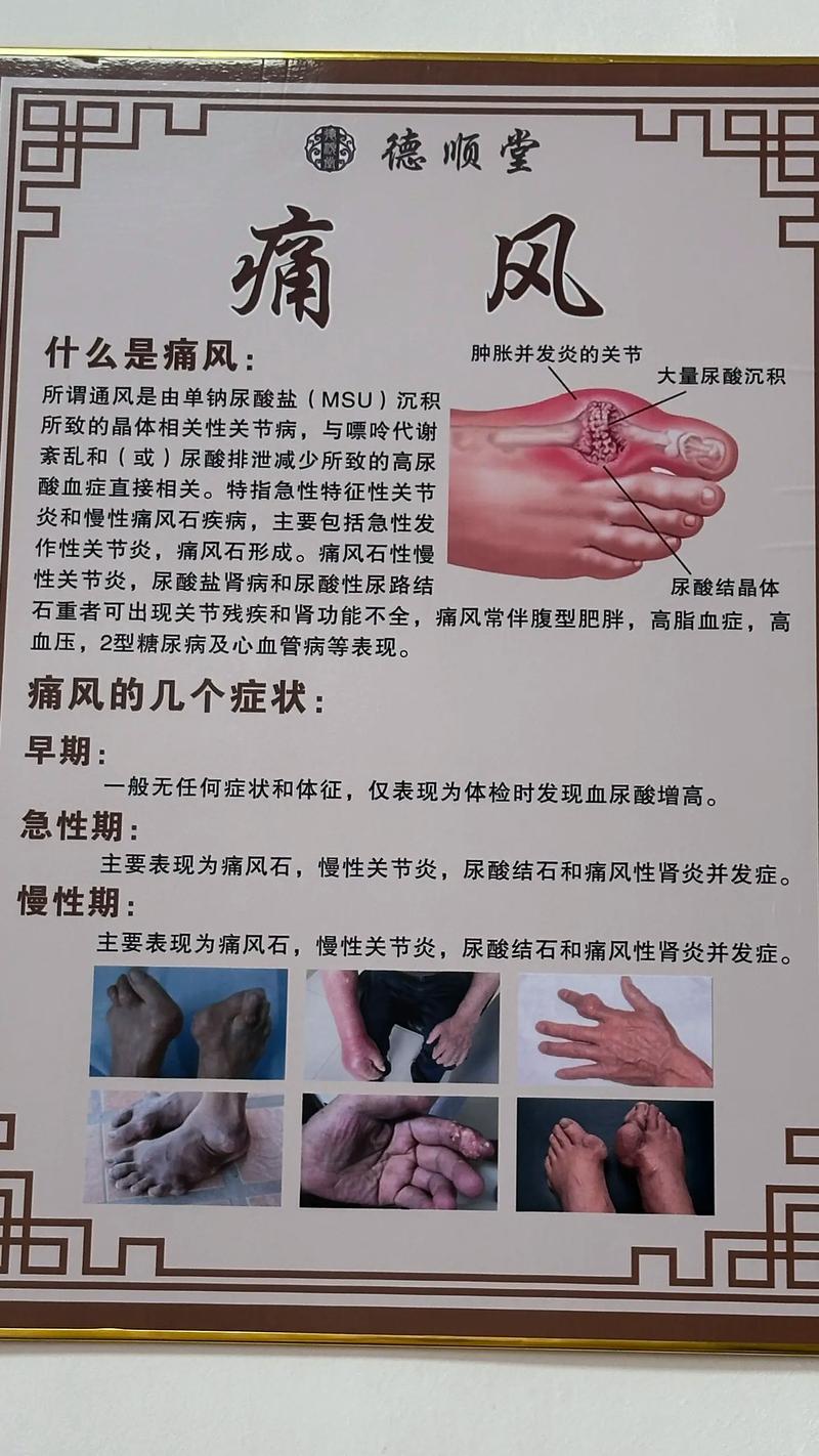 如何判断是否得了痛风