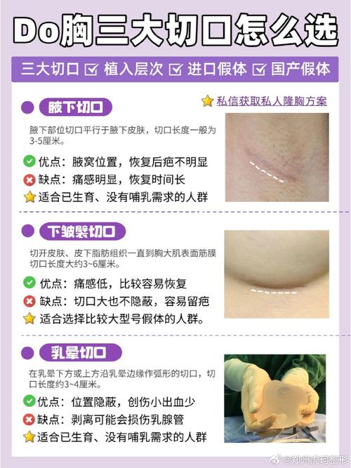 隆胸手术怎么做最安全