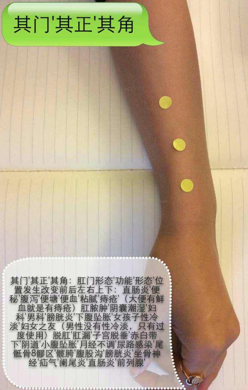 针灸治疗肠炎扎哪里