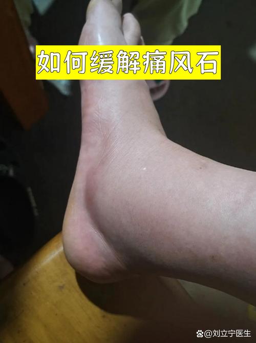 痛风怎么看有没有结晶