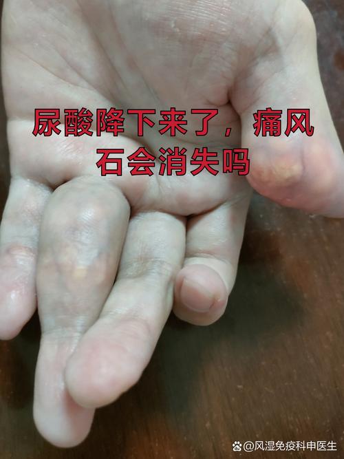 痛风怎么看有没有结晶