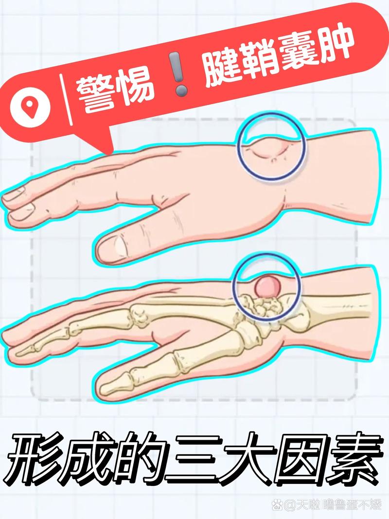 怎么区分腱鞘炎和痛风