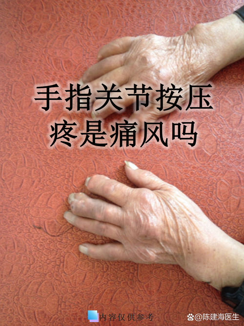 怎么区分腱鞘炎和痛风