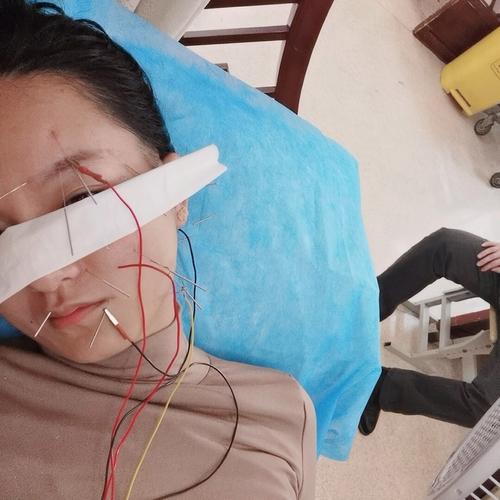 面瘫针灸脸上长满痘