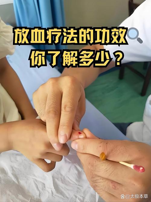 针灸治疗经间期出血