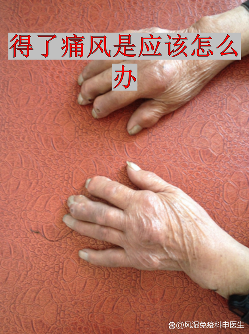 早期痛风的症状是什么