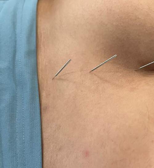 针灸真能治好痔疮吗