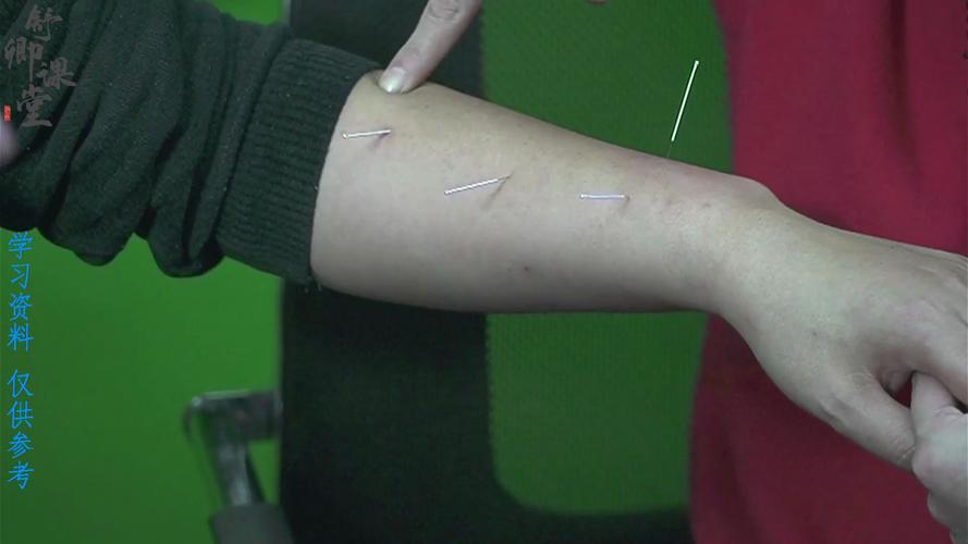 针灸真能治好痔疮吗