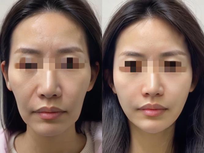 线雕和玻尿酸哪个安全