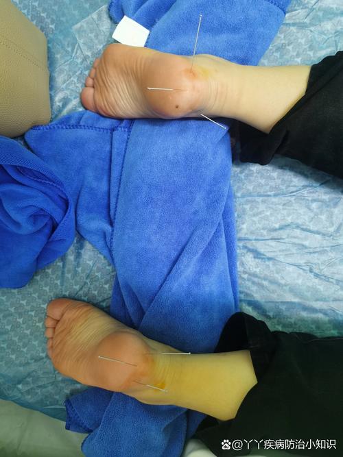 针灸后感觉脚跟很紧