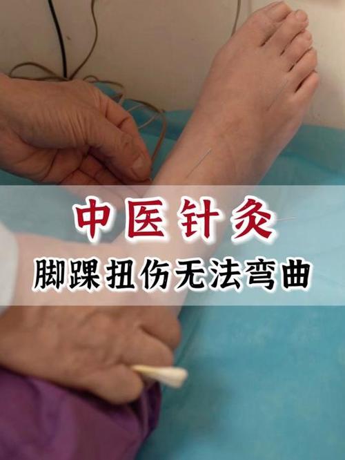 脚扭伤中医针灸治疗