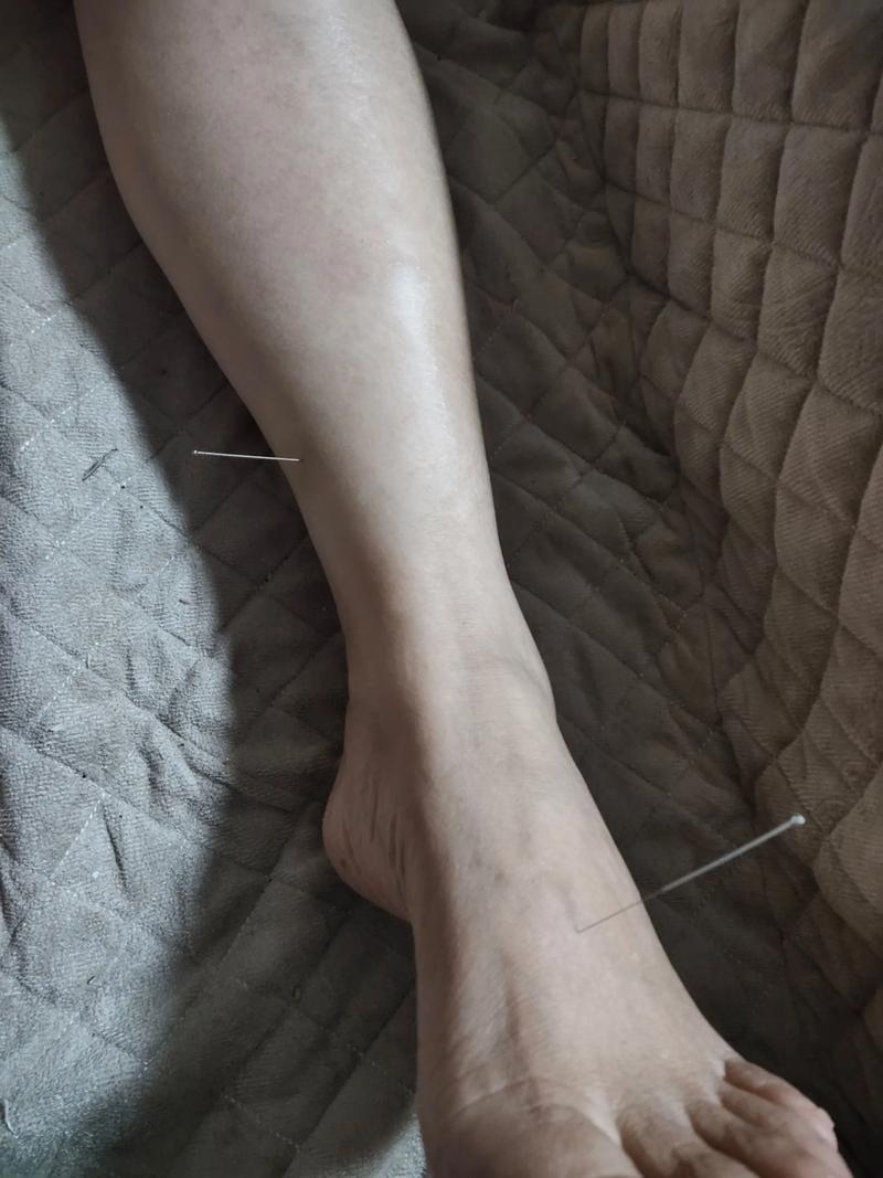 针灸可以治疗寒腿吗
