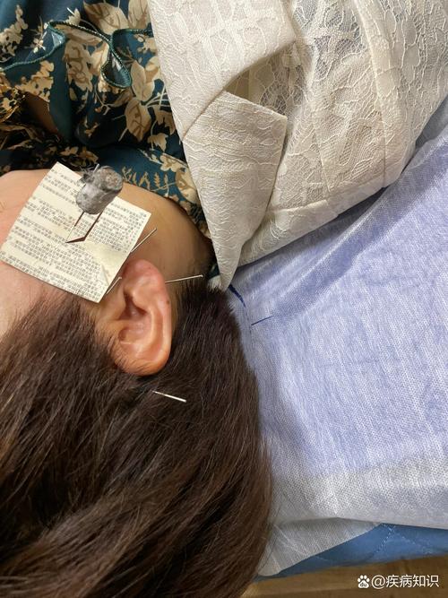 面瘫针灸针哪边最好