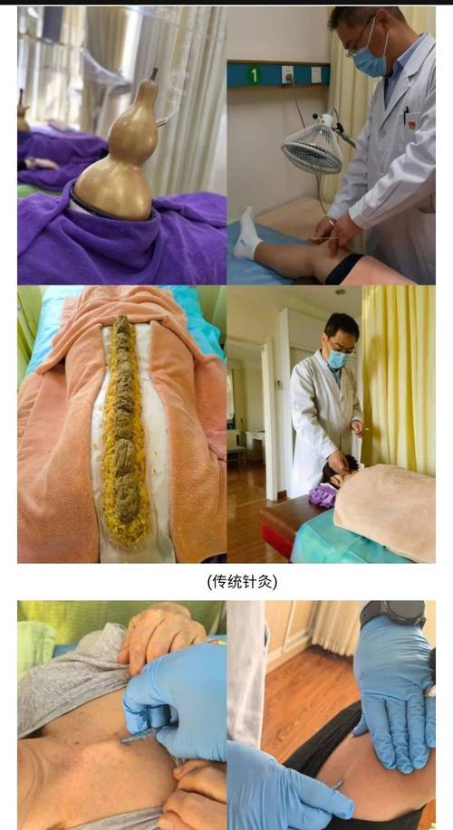 滑膜炎针灸治疗视频