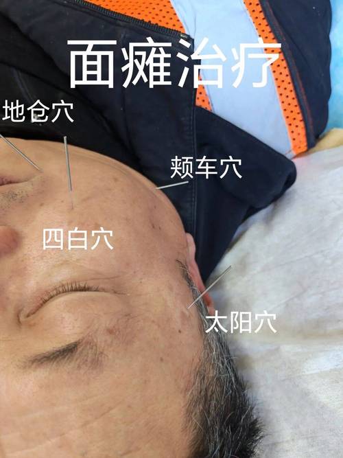 右边脸面瘫针灸部位