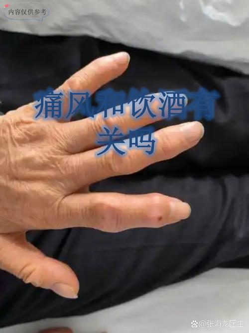 痛风好了可以喝白酒吗