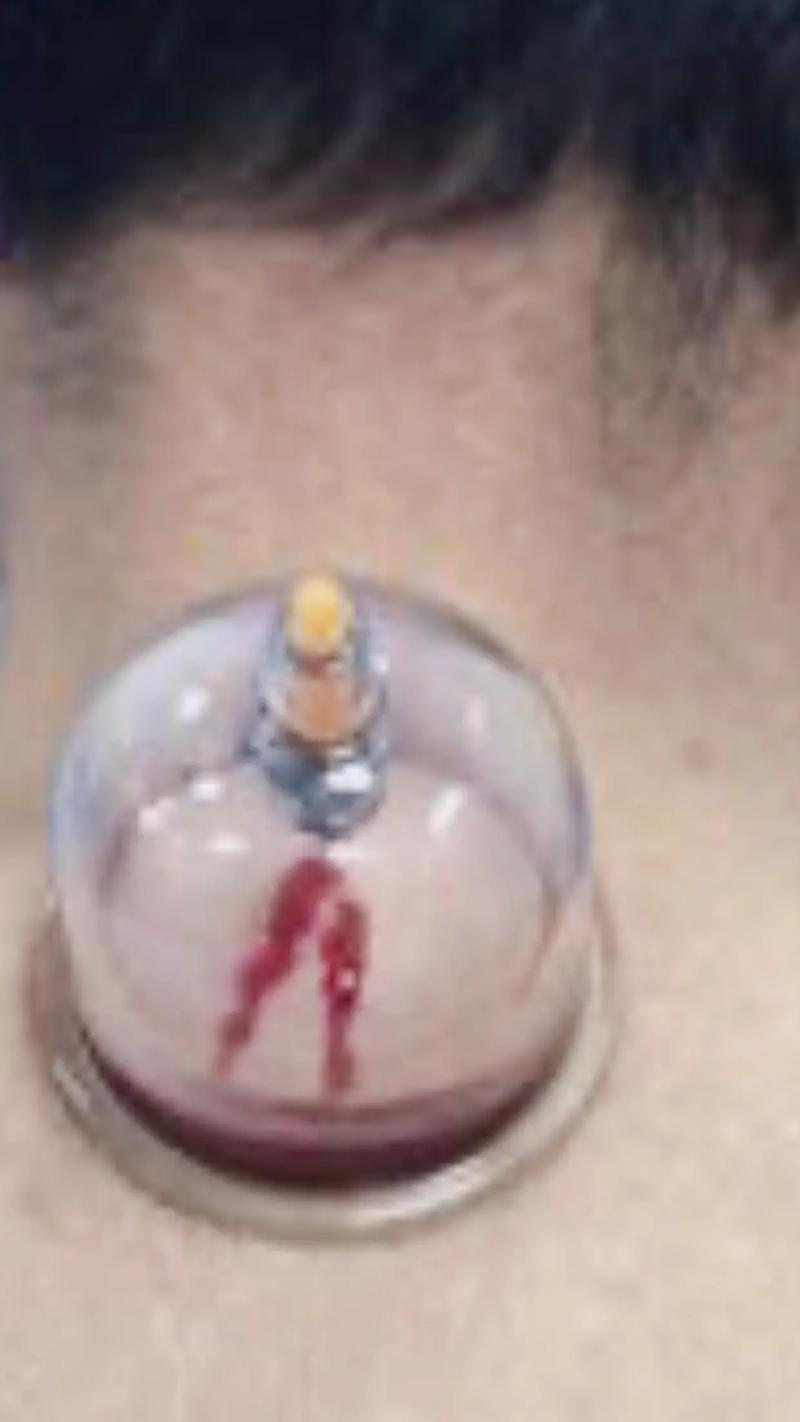 湿气重背部针灸放血