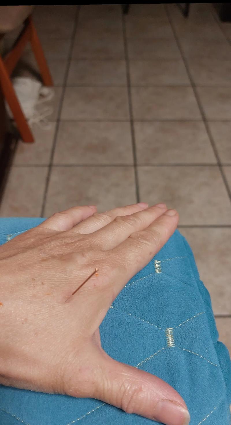 阳明头痛的针灸治疗