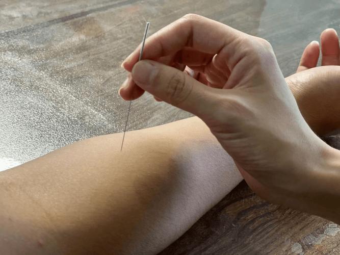 阳明头痛的针灸治疗