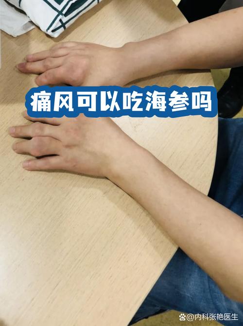 海参痛风病人可以吃吗