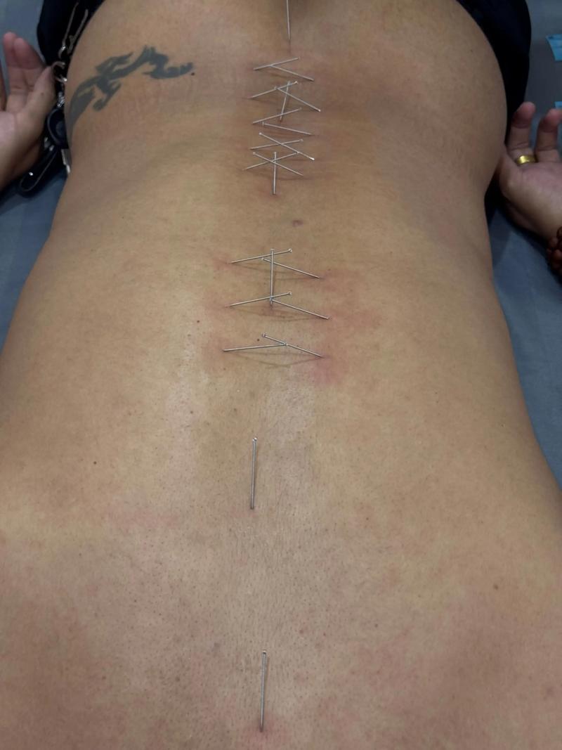 大伏天针灸治疗腰痛