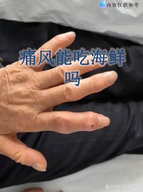 痛风的人可以吃钙片吗