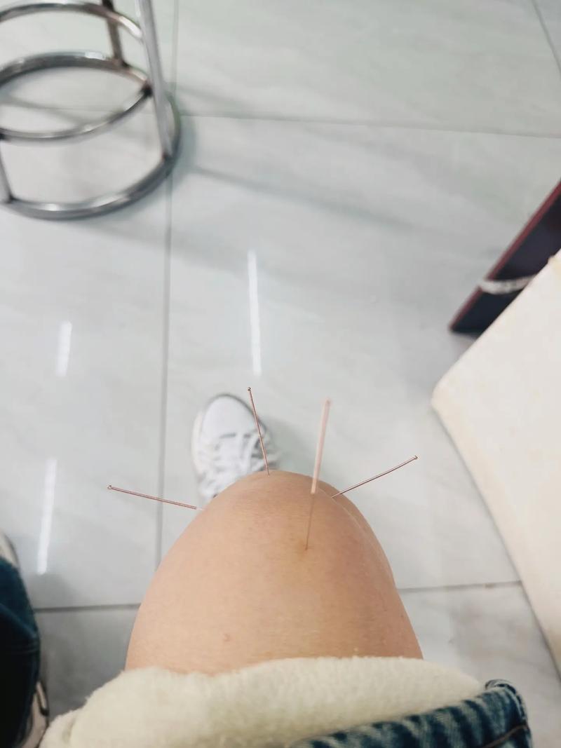 月子腿疼针灸管用吗