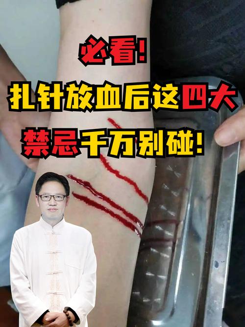 针灸减肥出血正常吗