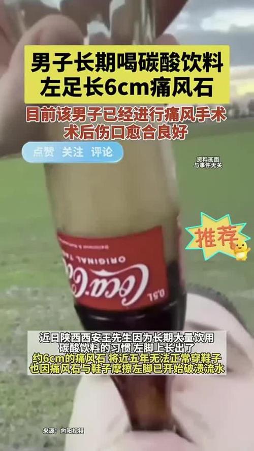 碳酸饮料会引起痛风吗