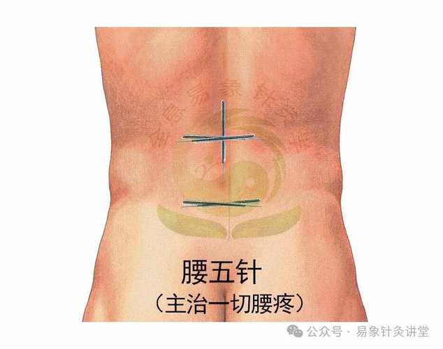 怀孕腰痛可以针灸吗