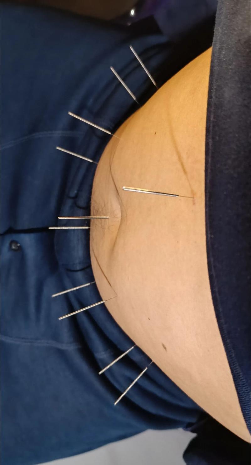 针灸丰胸根本没效果