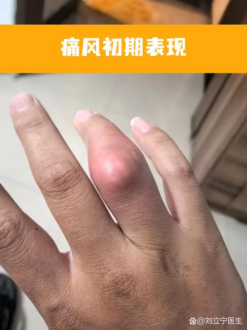 痛风的早期症状及治疗