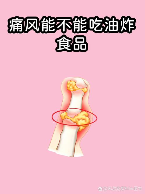 痛风可以吃油炸食品吗