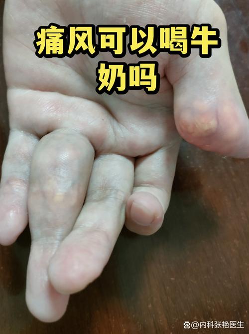 痛风患者可以喝牛奶吗