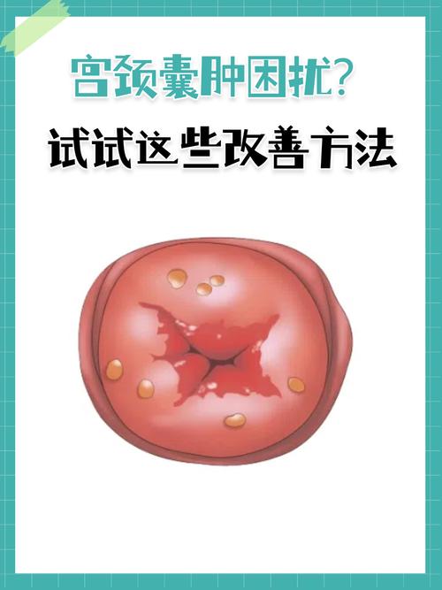 宫颈囊肿可以针灸吗