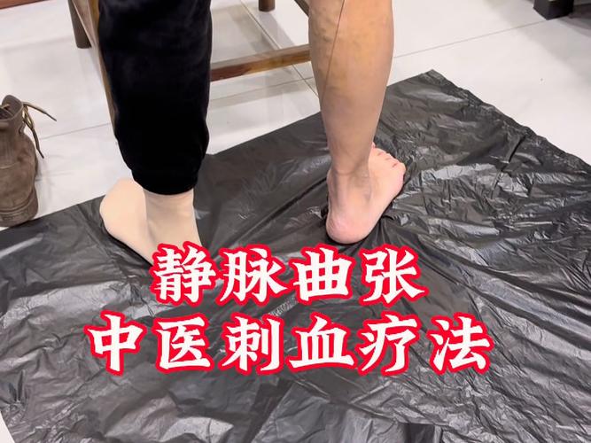 静脉曲张 中医针灸