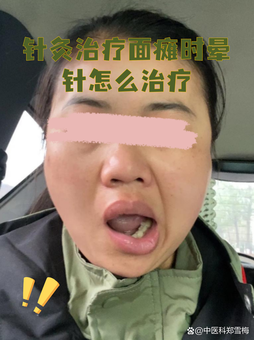 针灸治疗面瘫副作用