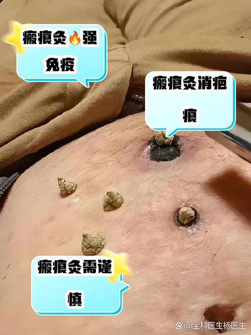 针灸完了可以艾灸吗