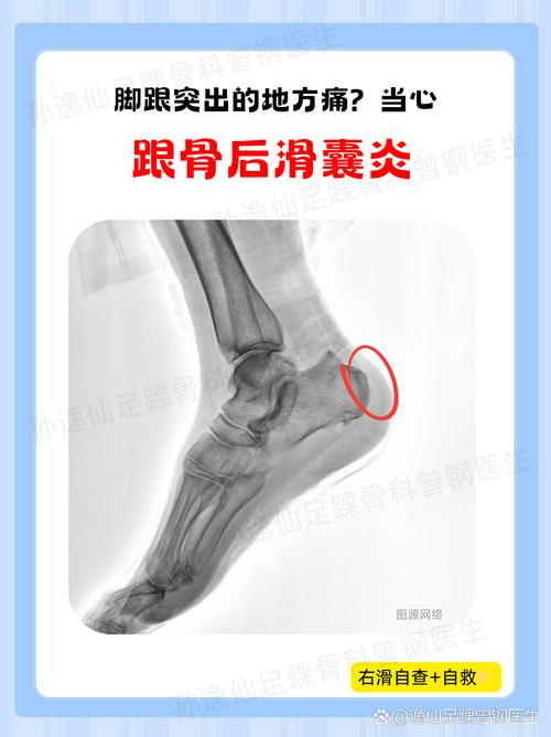 脚后跟疼是痛风的前兆