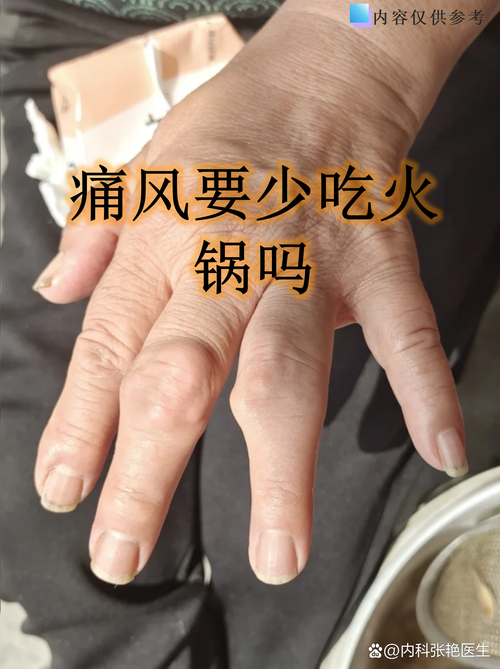 痛风能不能吃羊肉火锅