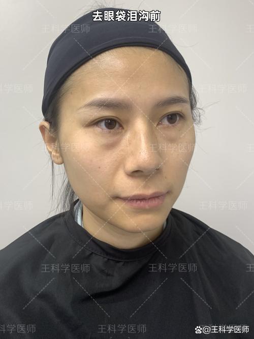 去眼袋手术真的安全吗