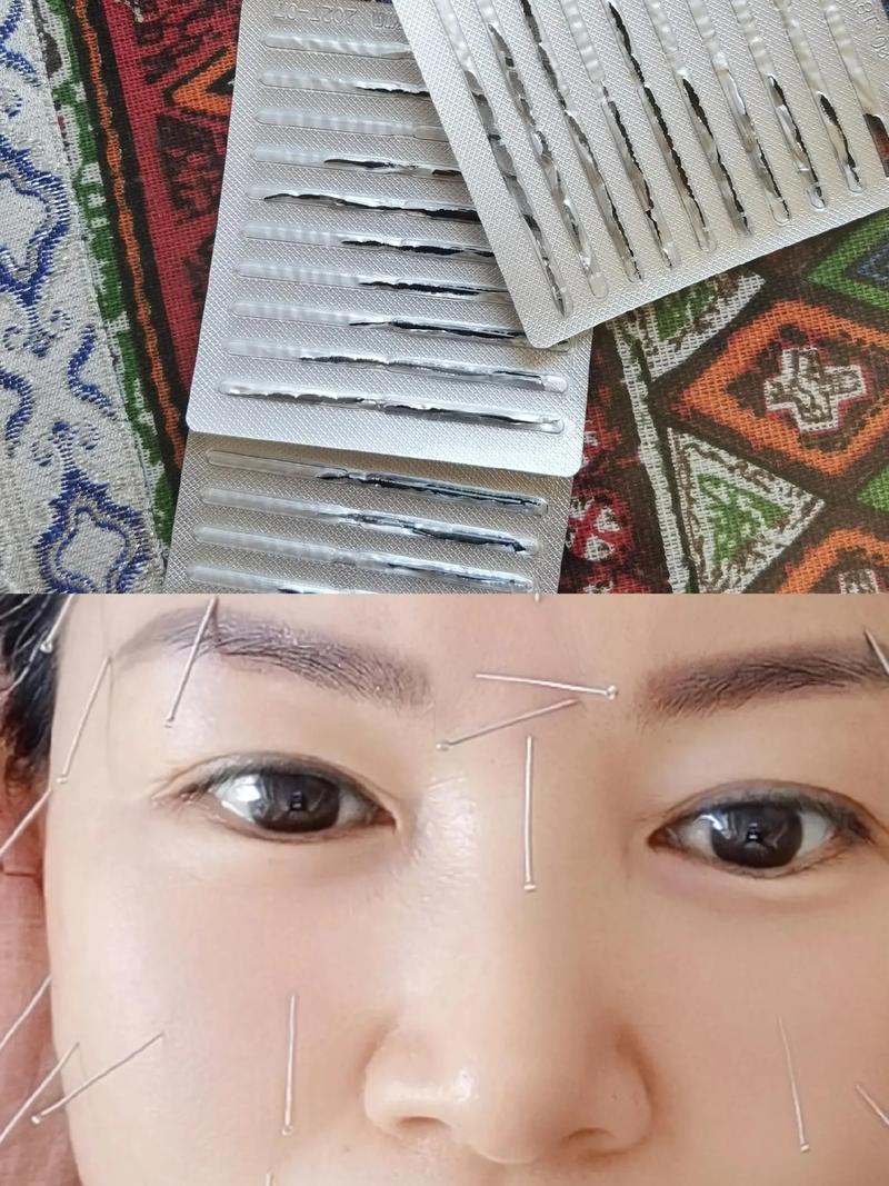 脸部过敏的针灸治疗