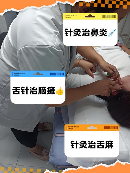 针灸舌头能治疗方法